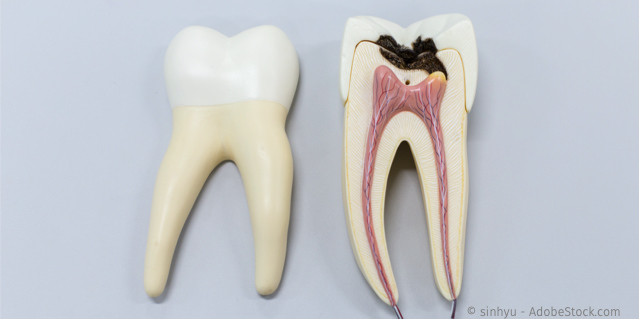 Warum können Zahnnerven absterben?