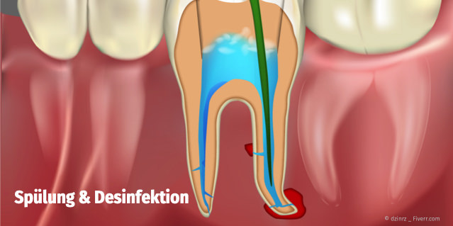 Spülung und Desinfektion der Wurzelkanäle